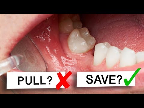 Can Loose Teeth Be Saved? To Pull or Not To Pull