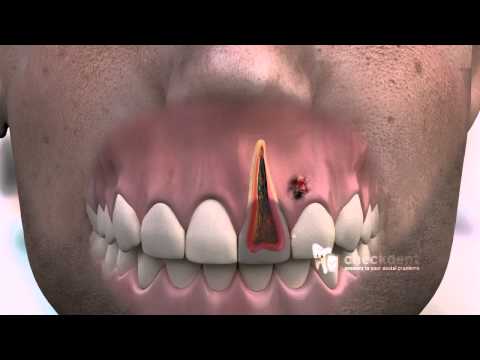 How to treat a dental Fistula