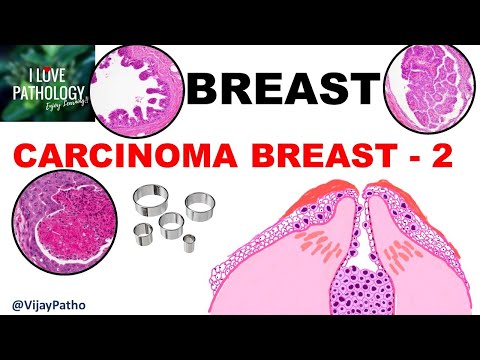 Diseases of Breast: Part 5: Breast carcinoma- DCIS, LCIS & Paget's Disease of Nipple